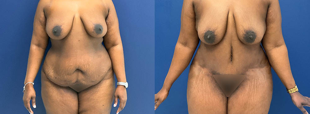 Tummy Tuck Before and After