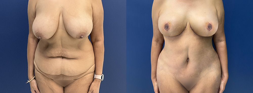Mommy Makeover Before and After