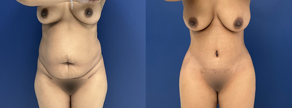Tummy Tuck Before and After