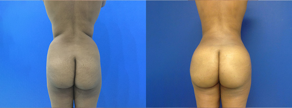 BBL Before and After