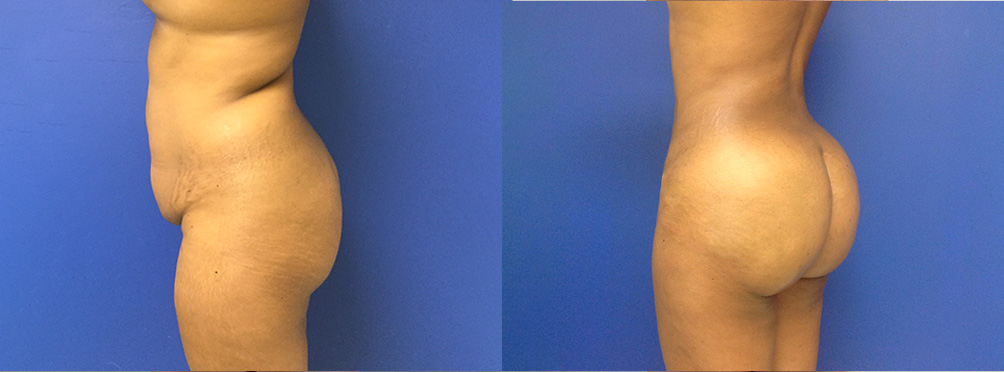 BBL Before and After