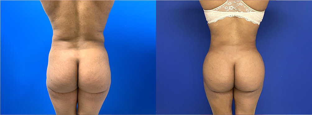 BBL Before and After