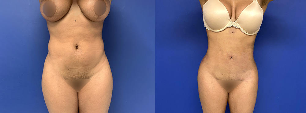 BBL Before and After