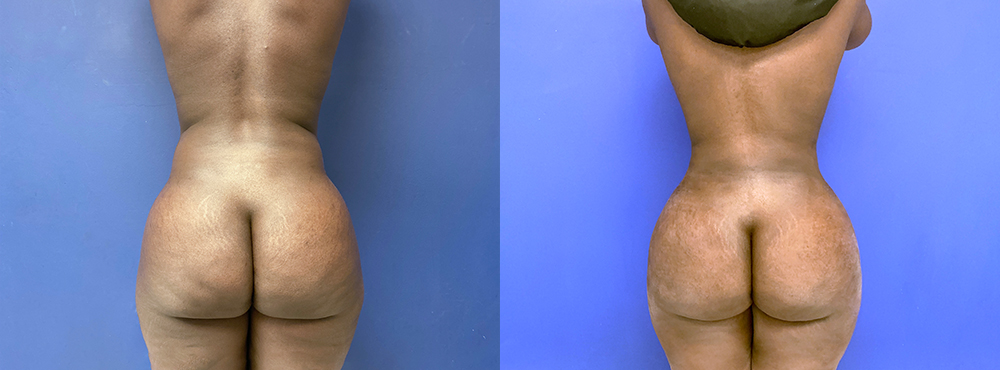 BBL Before and After