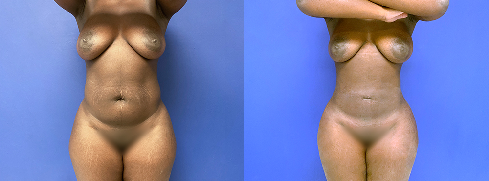 BBL Before and After