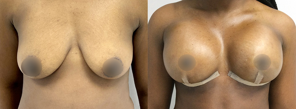 Breast Lift Before and After