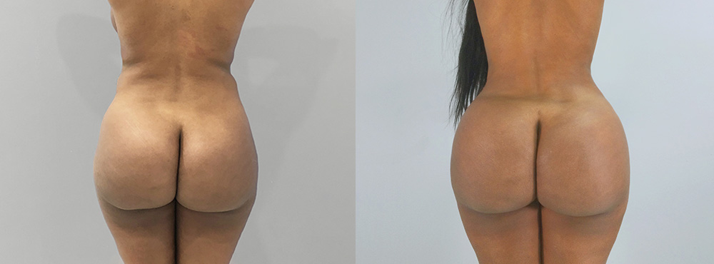 BBL Before and After