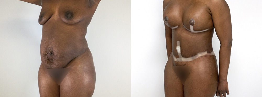 Mommy Makeover Before and After