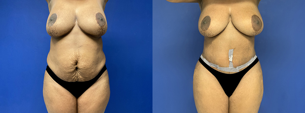 Tummy Tuck Before and After