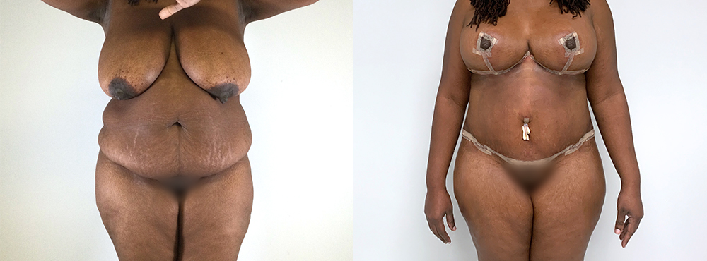 Mommy Makeover Before and After