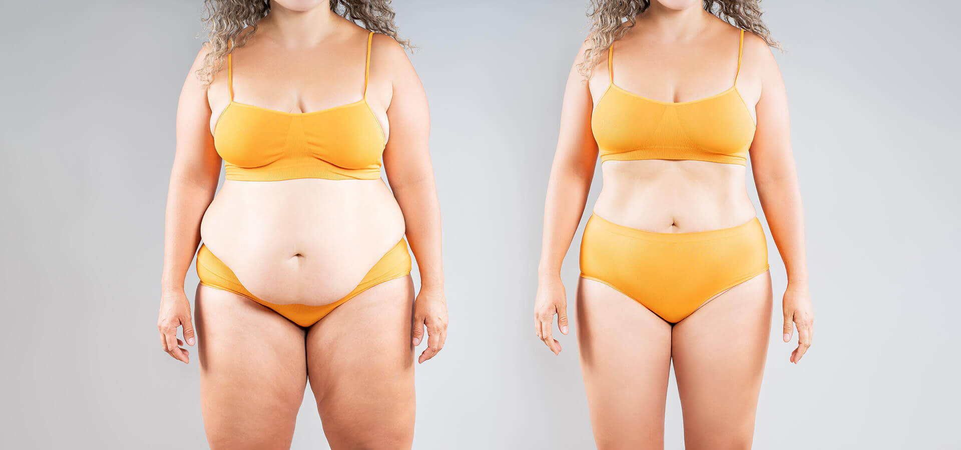 abdominoplastia sin drenaje frente a las opciones tradicionales