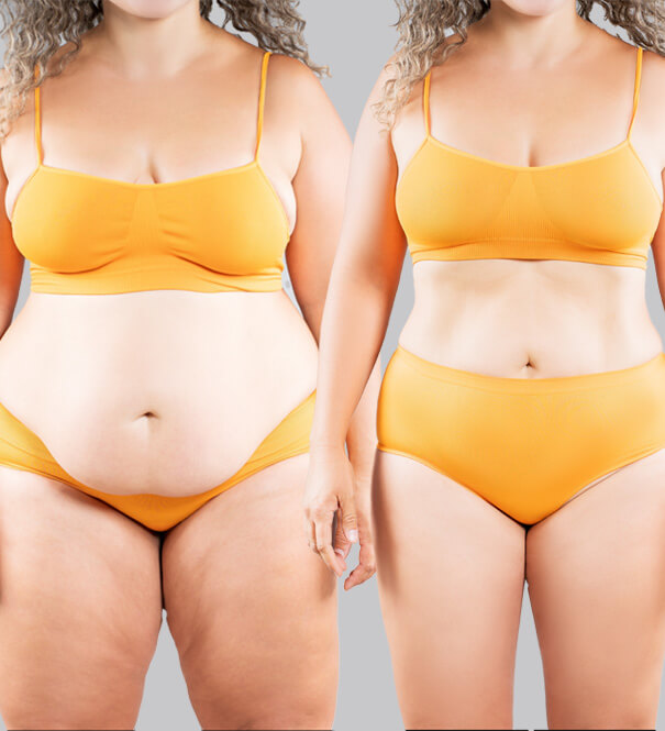 Exploring Drainless Tummy Tucks Against Traditional Options