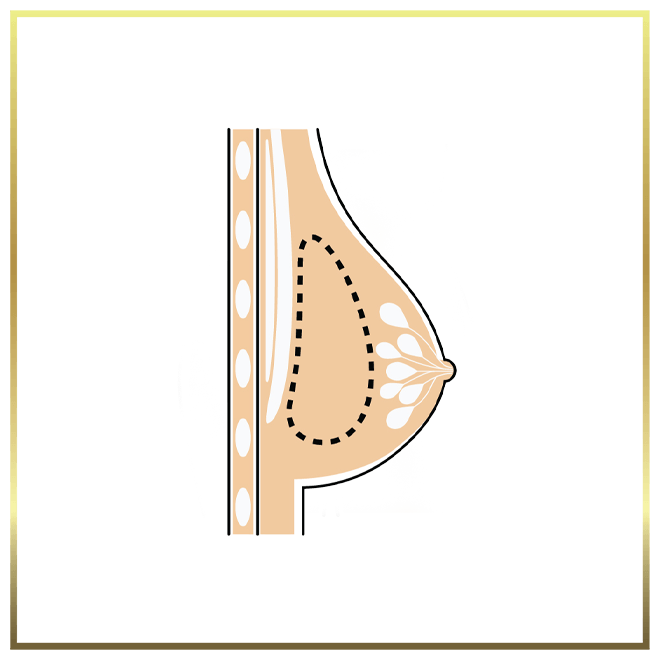 Breast Implant Revision