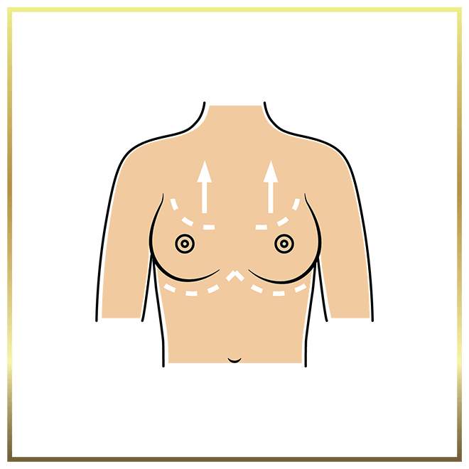 Breast Lift