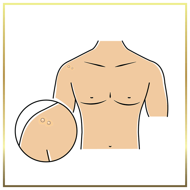 Warts/Verrucas Removal