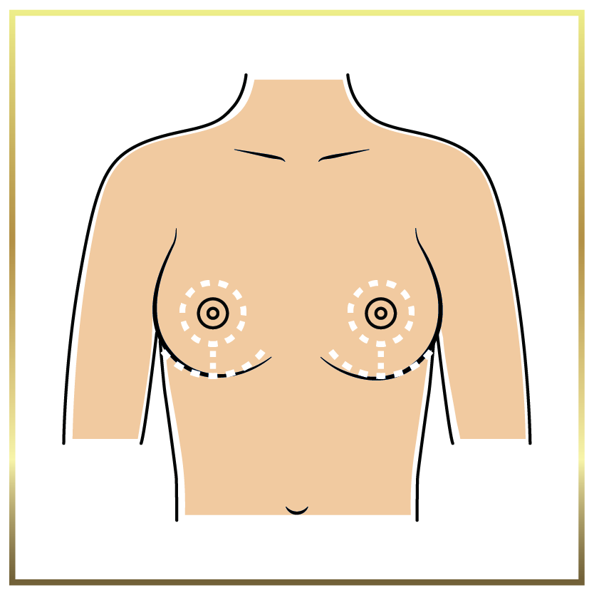 Breast Reduction Miami - $4000 Mammoplasty