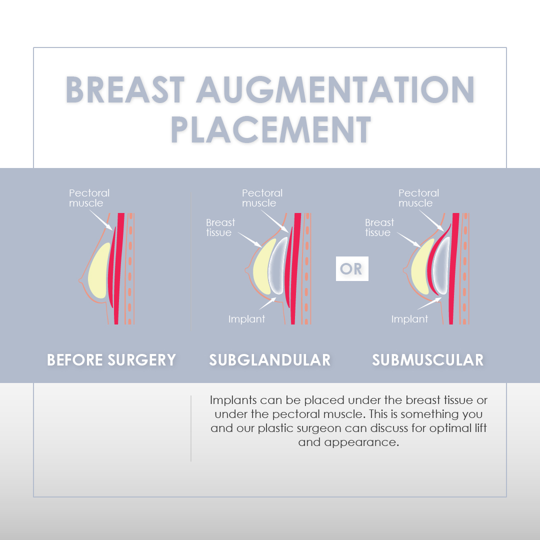 Alila Medical Media, Placement of breast implant for breast augmentation.