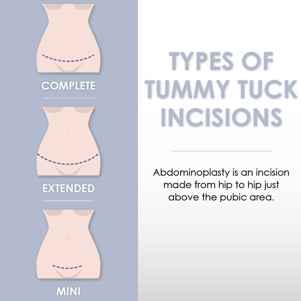 Tummy Tuck Surgery - Abdominoplasty in Miami
