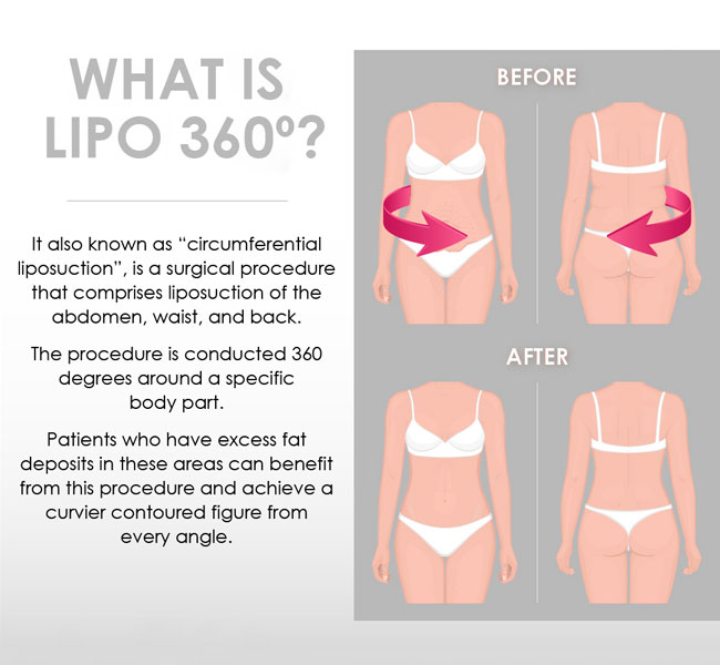 Lipo 360: One Path to Achieving Balanced Body Contours