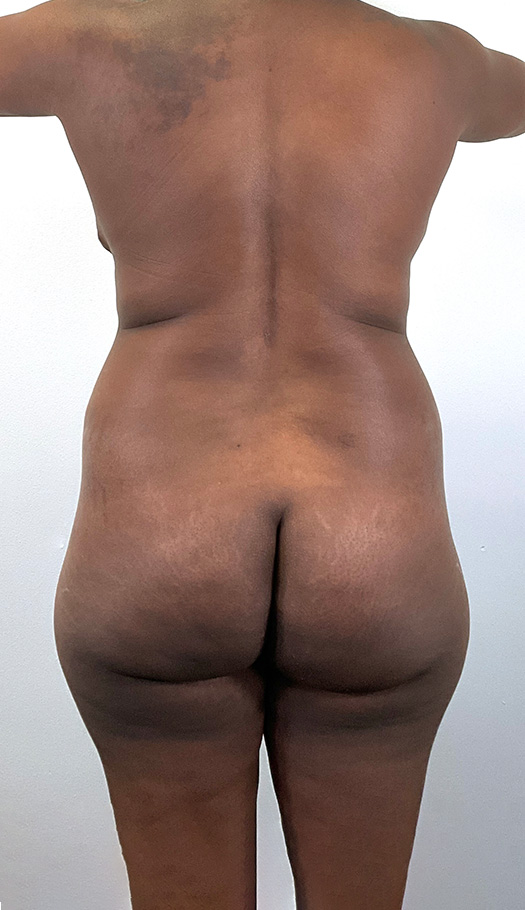 brazilian butt lift by dr hasan 136055 before