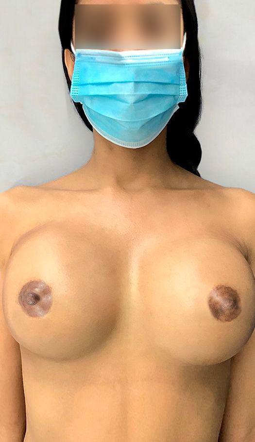 breast augmentation by dr golio 26426 after