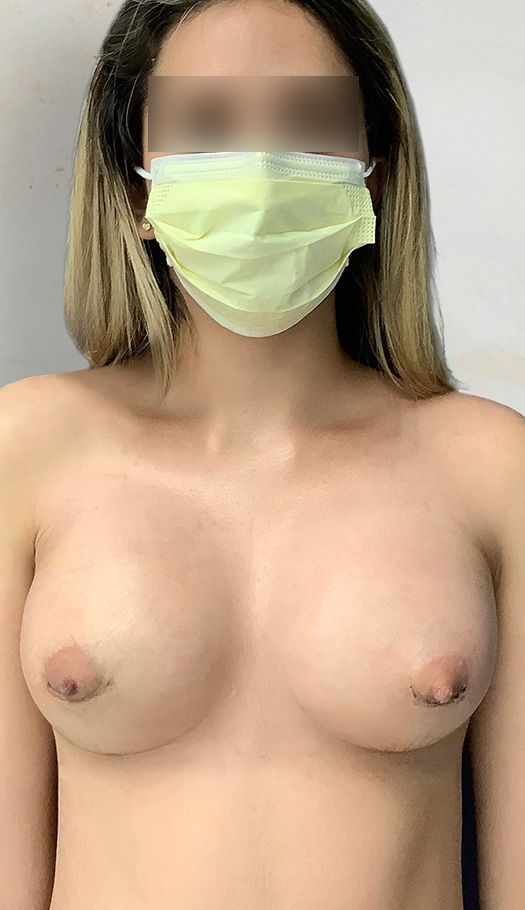 breast augmentation by dr golio 80186 after