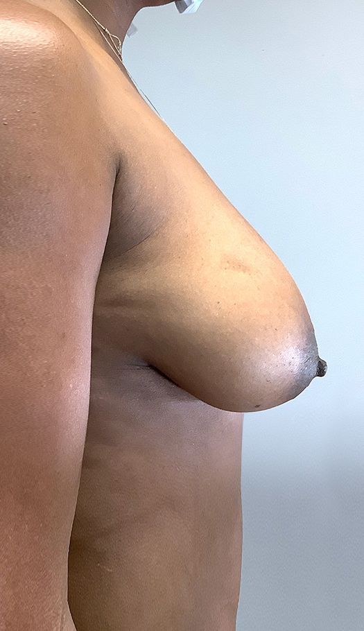 How to Hide Your Breast Lift Scars Post Mastopexy