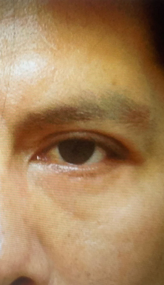 eyelid surgery 1 after