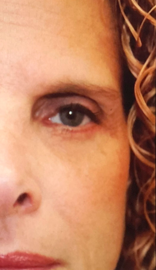 eyelid surgery 2 after