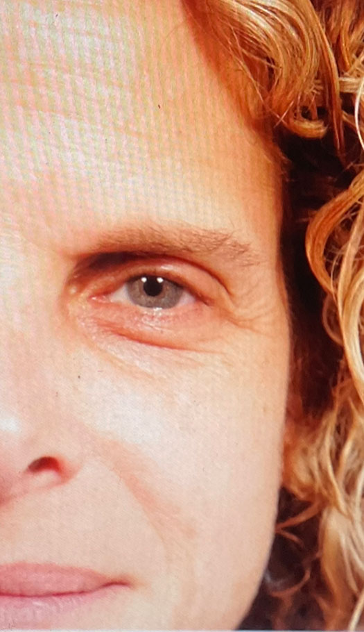 eyelid surgery 2 before