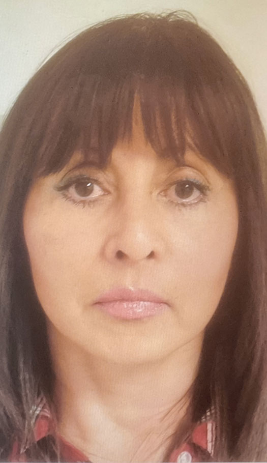 eyelid surgery 3 after