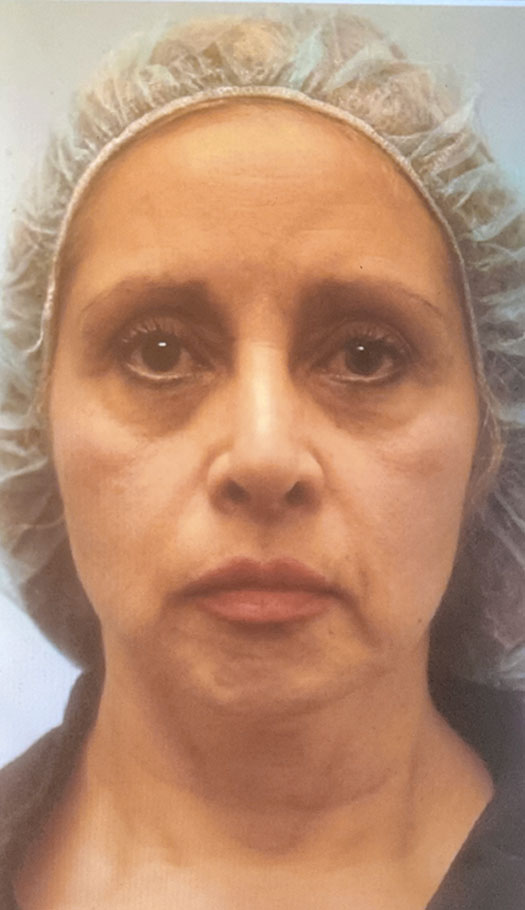 eyelid surgery 3 before