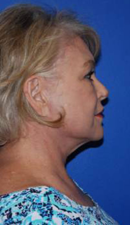 facelift 1 after