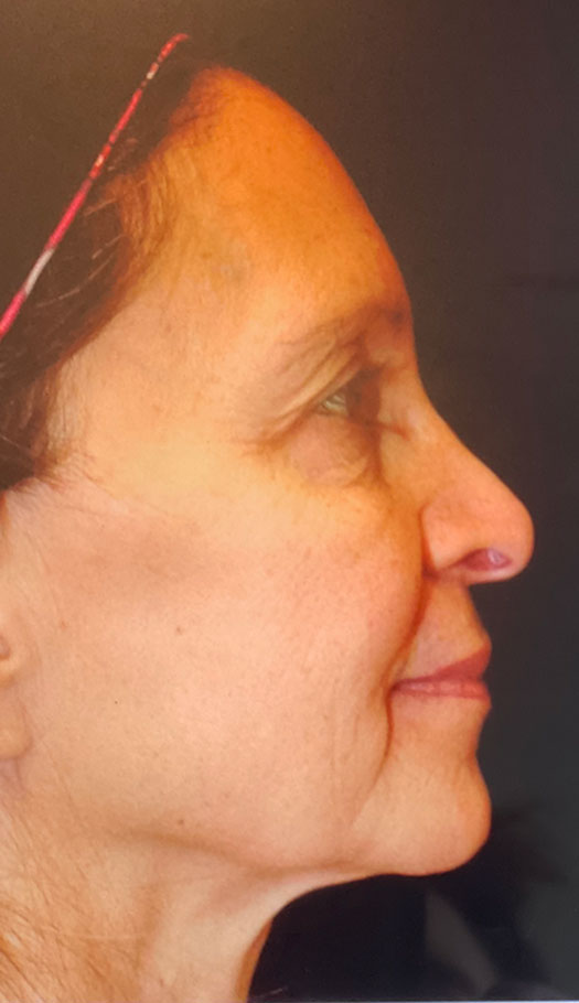 facelift 2 before