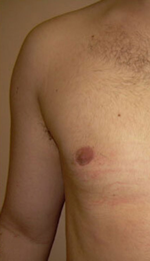 gynecomastia surgery 1 after