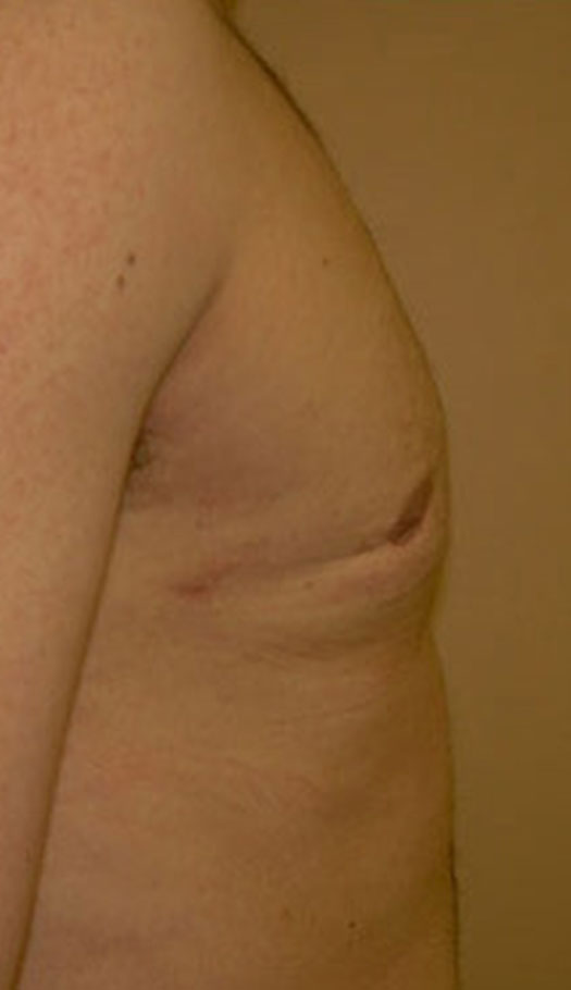 gynecomastia surgery 2 after