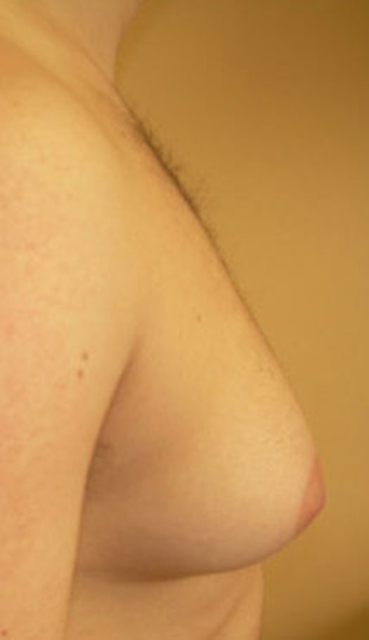 gynecomastia surgery 2 before