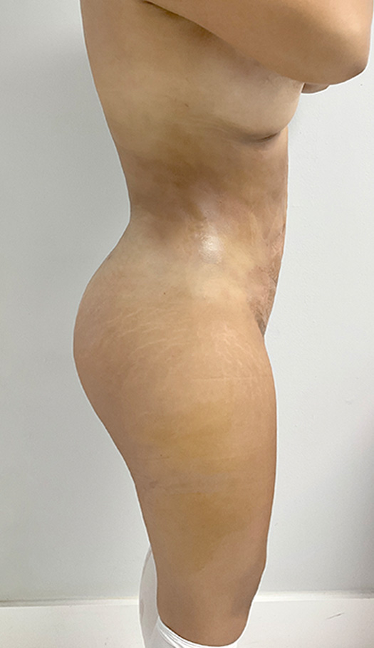 liposuction by dr luster 82928 after
