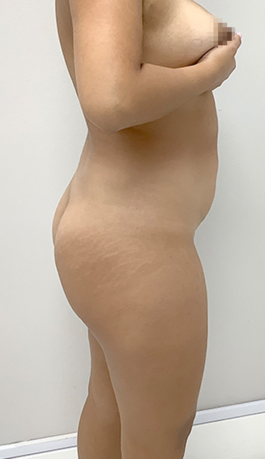 liposuction by dr luster 82928 before