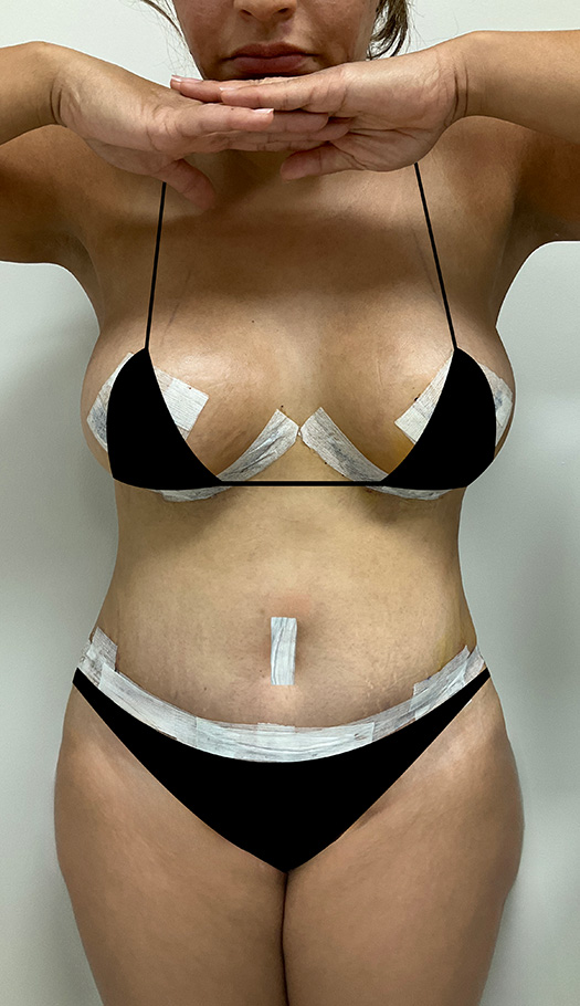 mommy makeover by dr pane 298570 after