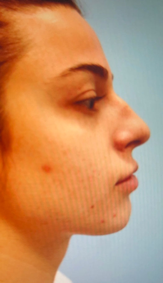 rhinoplasty 2 before