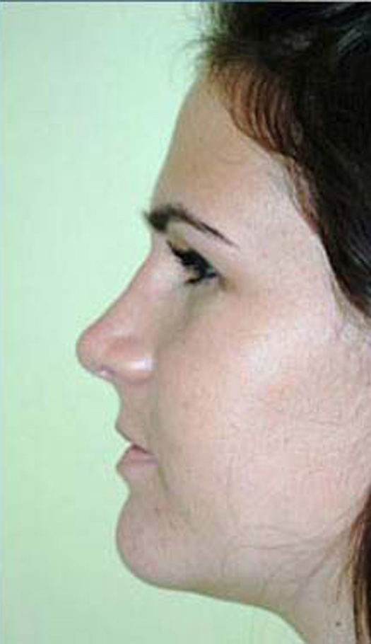 rhinoplasty 3 after