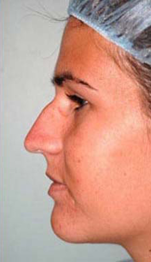 rhinoplasty 3 before
