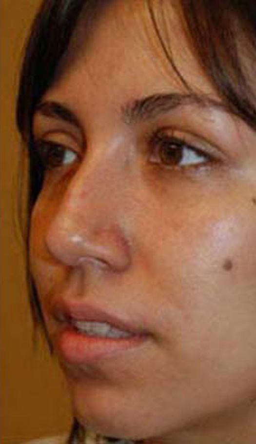 rhinoplasty 6 before