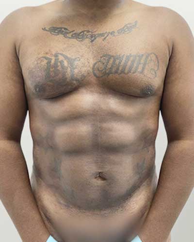 man six pack surgery after