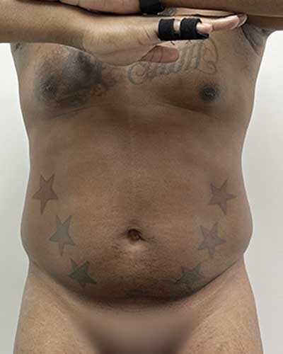 man six pack surgery before