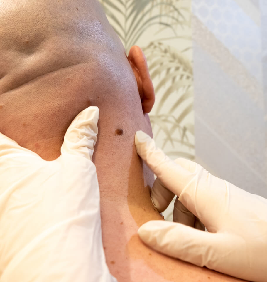 skin mole removal